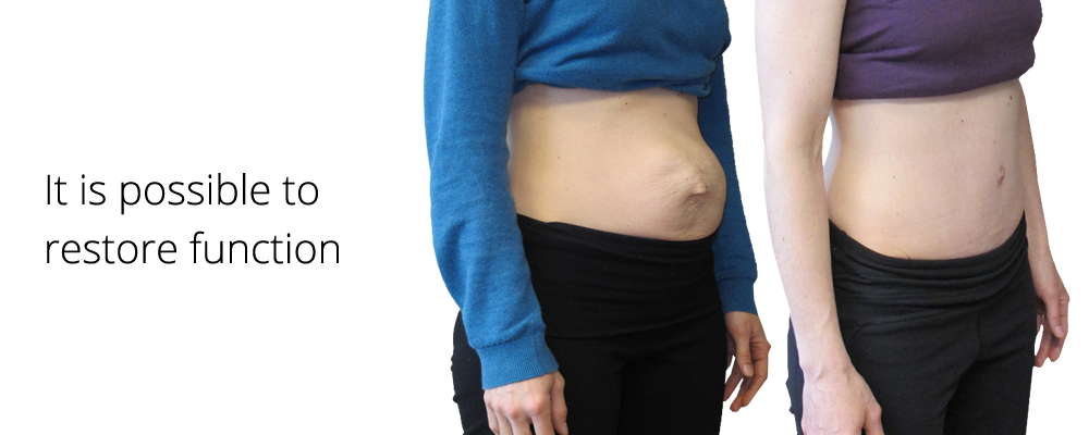Diastasis Rectus Abdominis  Baby Belly Pelvic Support by Diane Lee